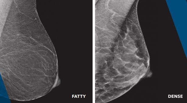 Dense Breast Tissue: What Does it Mean? - Mather Hospital